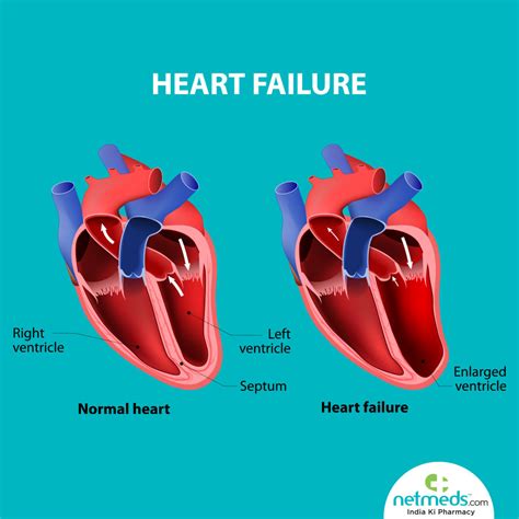 lv failure symptoms|what causes left ventricular dysfunction.